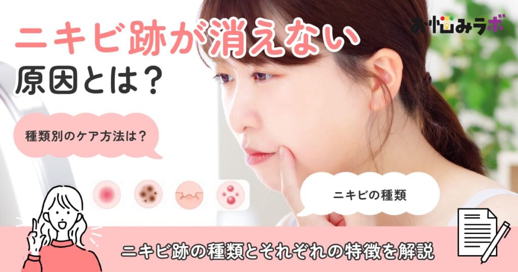 ニキビ跡が消えない原因とは？種類別に解説