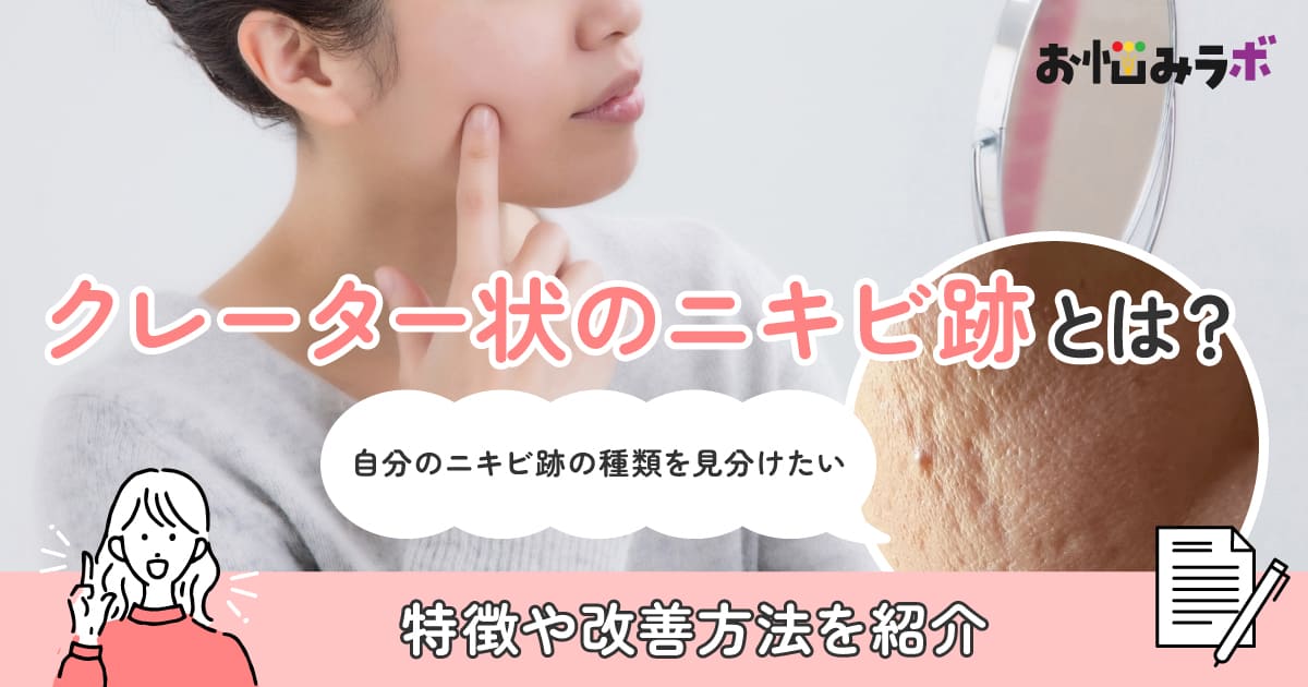 クレーター状のニキビ跡とは？特徴や改善方法を紹介