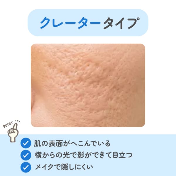 クレータータイプ