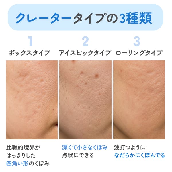 クレータータイプの3種類