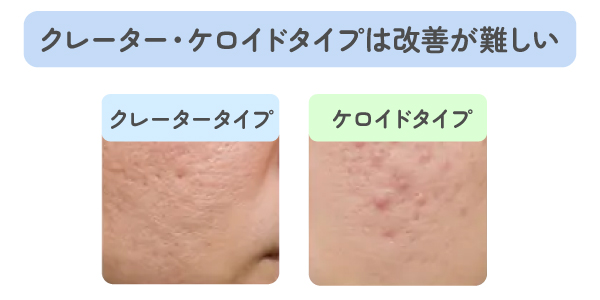 クレーター・ケロイドタイプは改善が難しい