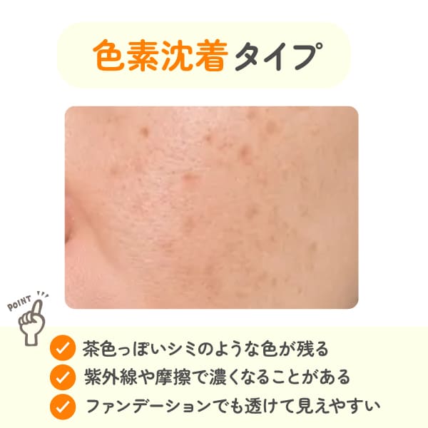 ニキビ跡｜色素沈着タイプ