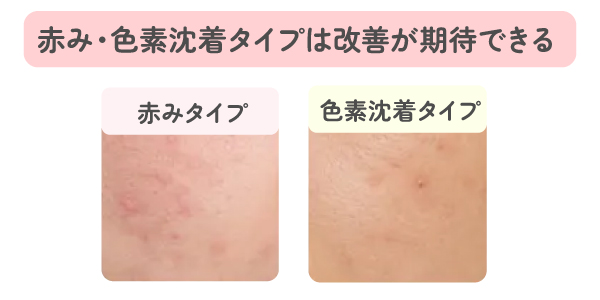 赤み・色素沈着タイプのニキビ跡は改善が期待できる