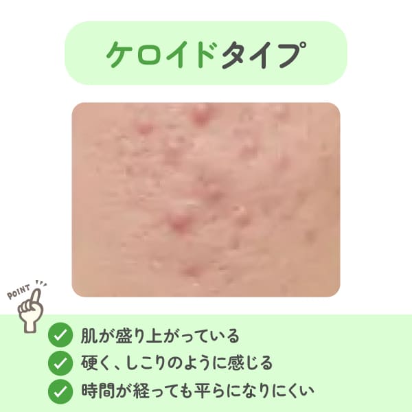 ニキビ跡｜ケロイドタイプ
