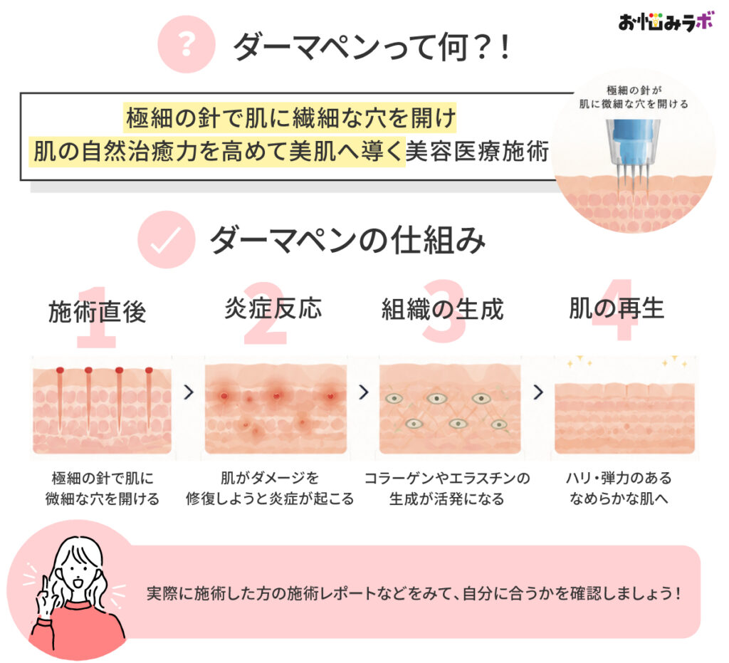 ダーマペンの仕組みを解説した図解イラスト。極細の針で肌に微細な穴を開け、コラーゲン生成と肌再生を促す流れを説明した画像
