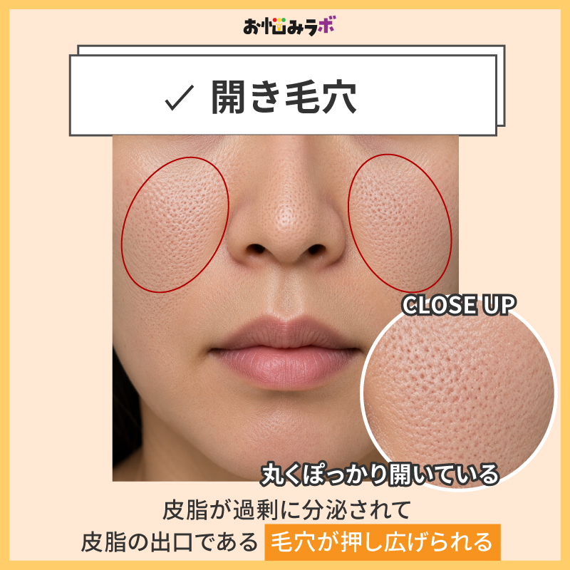 開き毛穴の特徴