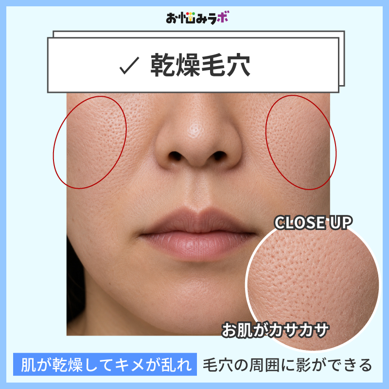 乾燥毛穴の特徴
