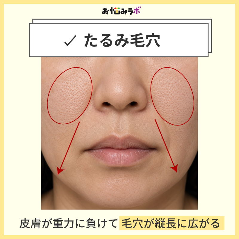 たるみ毛穴の特徴