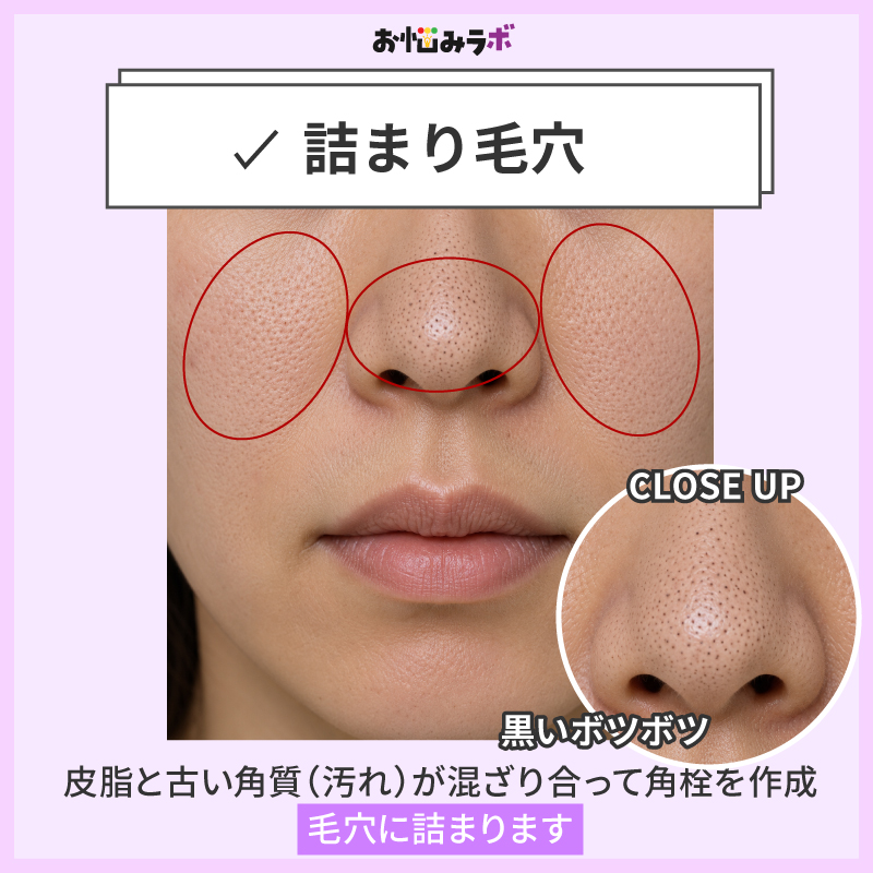 詰まり毛穴の特徴